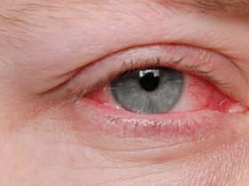 A new Covid variant, which has been found to be more infectious, is said to have an added rare symptom of conjunctivitis or pinkeye. 
