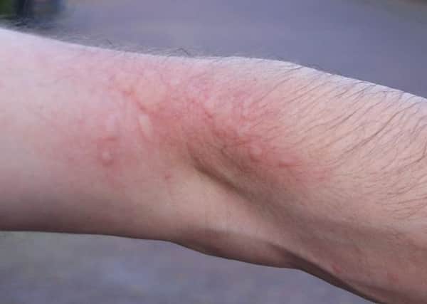 A rash caused by oak processionary moth hairs (with permission of the Oak Processionary Moth Project, Forestry Commission)
