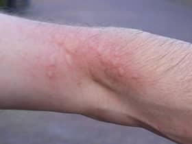 A rash caused by oak processionary moth hairs (with permission of the Oak Processionary Moth Project, Forestry Commission)