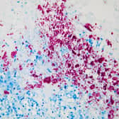 Ziehl-Nielsen staining and histological examination of tissues from this case showing extensive acid-fast bacteria (red colonies) characteristic of Johne’s disease (MAP). (Pic: AFBI)